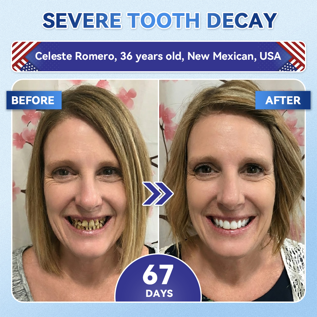 𝐆𝐥𝐢𝐦𝐦𝐞𝐫𝐥𝐲® 𝐓𝐢𝐝𝐞𝐠𝐥𝐮𝐬𝐢𝐛 𝐓𝐨𝐨𝐭𝐡 & 𝐆𝐮𝐦 𝐑𝐞𝐩𝐚𝐢𝐫 𝐌𝐢𝐜𝐫𝐨𝐧𝐞𝐞𝐝𝐥𝐞 𝐏𝐚𝐭𝐜𝐡🩹  | 𝐀𝐝𝐯𝐚𝐧𝐜𝐞𝐝 𝐒𝐭𝐞𝐦-𝐂𝐞𝐥𝐥 𝐀𝐜𝐭𝐢𝐯𝐚𝐭𝐢𝐨𝐧 𝐓𝐞𝐞𝐭𝐡 𝐒𝐭𝐫𝐢𝐩𝐬(🦷𝐑𝐞𝐛𝐮𝐢𝐥𝐝 𝐄𝐧𝐚𝐦𝐞𝐥 & 𝐃𝐞𝐧𝐭𝐢𝐧 • 𝐒𝐭𝐫𝐞𝐧𝐠𝐭𝐡𝐞𝐧 𝐆𝐮𝐦𝐬 • 𝐄𝐫𝐚𝐝𝐢𝐜𝐚𝐭𝐞 𝐓𝐚𝐫𝐭𝐚𝐫 & 𝐎𝐝𝐨𝐫 • 𝐒𝐭𝐨𝐩 𝐓𝐨𝐨𝐭𝐡 𝐒𝐞𝐧𝐬𝐢𝐭𝐢𝐯𝐢𝐭𝐲)💎