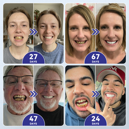 🦷𝐆𝐥𝐢𝐦𝐦𝐞𝐫𝐥𝐲® 𝐓𝐢𝐝𝐞𝐠𝐥𝐮𝐬𝐢𝐛 𝐓𝐨𝐨𝐭𝐡 & 𝐆𝐮𝐦 𝐑𝐞𝐩𝐚𝐢𝐫 𝐌𝐢𝐜𝐫𝐨𝐧𝐞𝐞𝐝𝐥𝐞 𝐏𝐚𝐭𝐜𝐡  | 𝐀𝐝𝐯𝐚𝐧𝐜𝐞𝐝 𝐒𝐭𝐞𝐦-𝐂𝐞𝐥𝐥 𝐀𝐜𝐭𝐢𝐯𝐚𝐭𝐢𝐨𝐧 𝐓𝐞𝐞𝐭𝐡 𝐒𝐭𝐫𝐢𝐩𝐬(🦷𝐑𝐞𝐛𝐮𝐢𝐥𝐝 𝐄𝐧𝐚𝐦𝐞𝐥 & 𝐃𝐞𝐧𝐭𝐢𝐧 • 𝐒𝐭𝐫𝐞𝐧𝐠𝐭𝐡𝐞𝐧 𝐆𝐮𝐦𝐬 • 𝐄𝐫𝐚𝐝𝐢𝐜𝐚𝐭𝐞 𝐓𝐚𝐫𝐭𝐚𝐫 & 𝐎𝐝𝐨𝐫 • 𝐒𝐭𝐨𝐩 𝐓𝐨𝐨𝐭𝐡 𝐒𝐞𝐧𝐬𝐢𝐭𝐢𝐯𝐢𝐭𝐲) ✈️